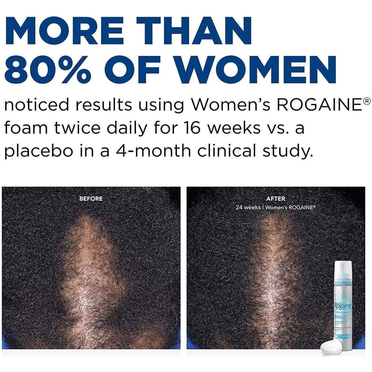 Rogaine Women’s 5% Minoxidil Foam 60ml (2 Month Supply)